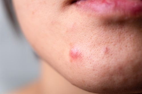 Best Hormonal Acne Treatment: Chin Pimples