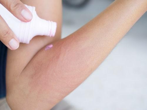 Calamine lotion for pimples deals