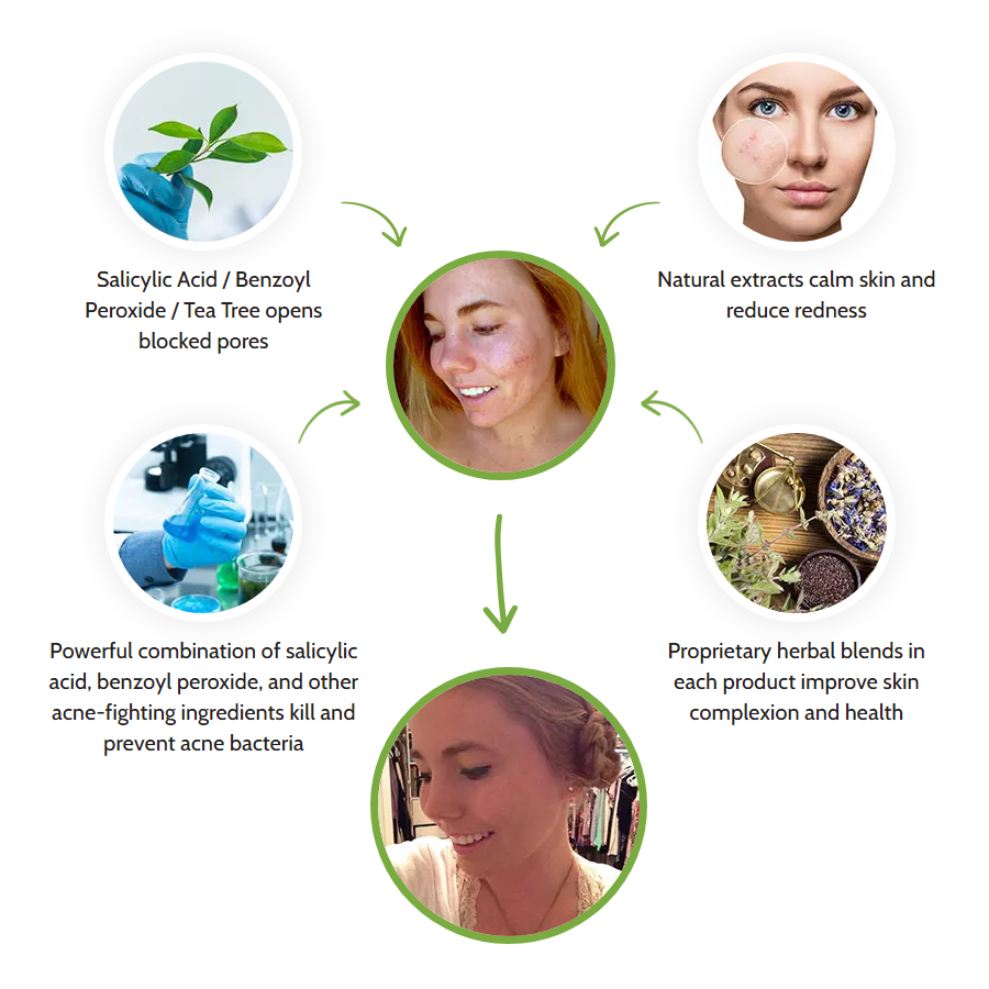 Exposed Works by unclogging pores with Salicylic Acid while natural extracts sooth the skin.  Benzoyl peroxide and other ingredients work to kill acne bacterial to address pimples and stop breakouts.