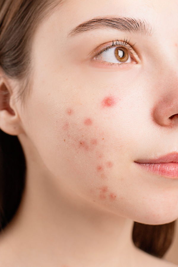 How to Get Rid of Hormonal Acne for Good