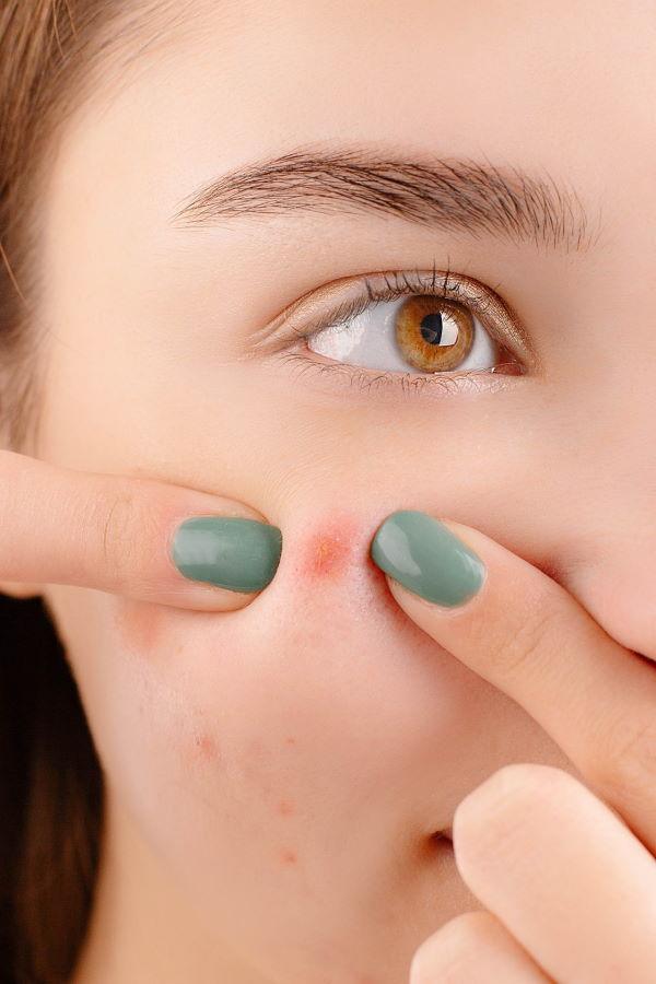 How to Pop a Pimple Responsibly