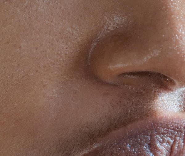 A Fast-Acting Treatment Plan for Nose Acne
