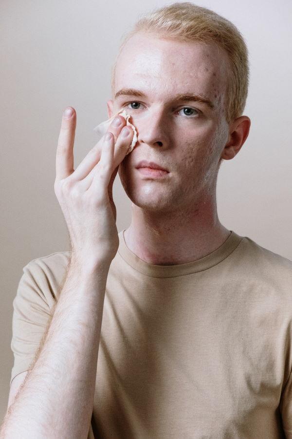 How Using Sulfur For Acne Can Improve Your Skin (With Exposed)