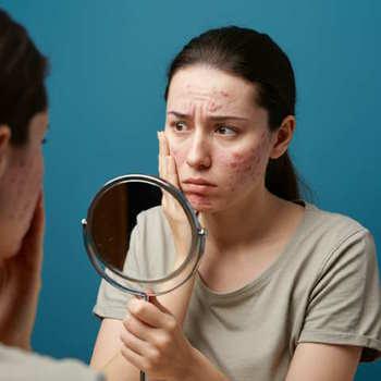 Treatment Of Acne Rosacea (Exposed Calms Without Irritating)