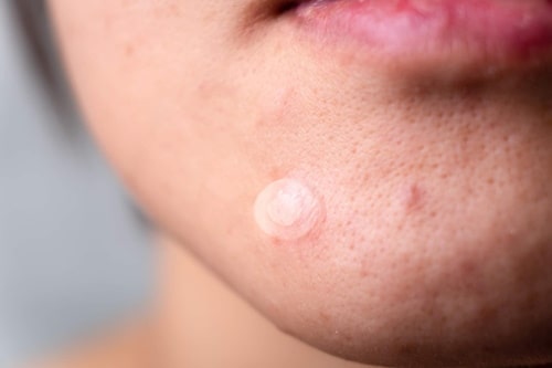 How Do Acne Patches Work? (And Why It’s Not the Best for Acne)