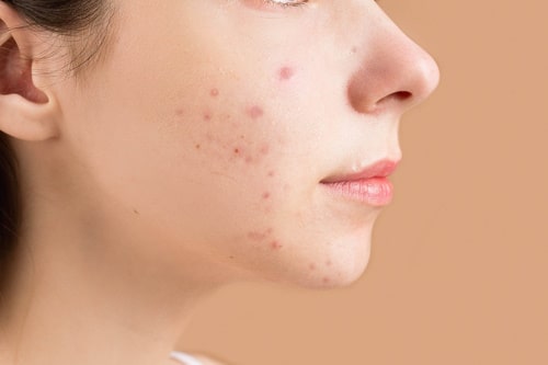 Acne Under The Skin: How to Get Rid of It