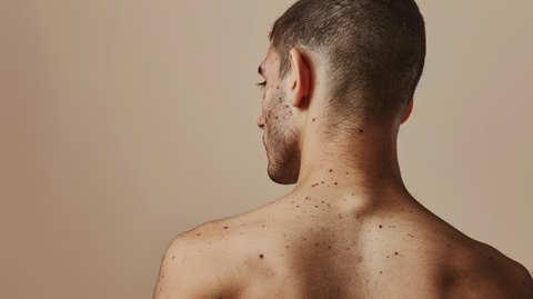 Back Acne Men Deal With Daily (Beat It With Exposed)