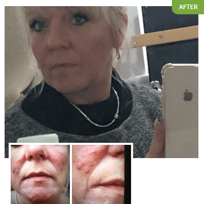 Claire before and after using Exposed Skin Care