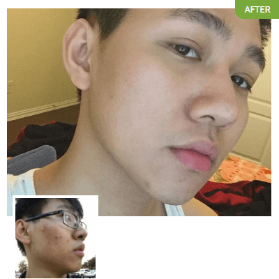 Gary Nguyen before and after using Exposed Skin Care
