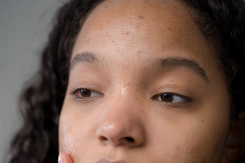 Acne Between Eyebrows: Causes and Solutions