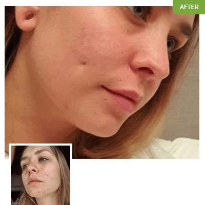 Jade before and after using Exposed Skin Care