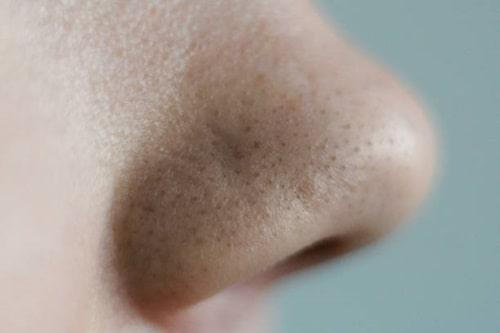 Are Blackheads Acne? (Exposed Clears Them For Good)