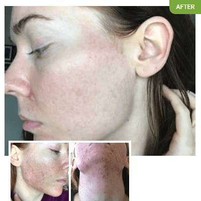 Exposed Skin Care - Rachelle Crouse