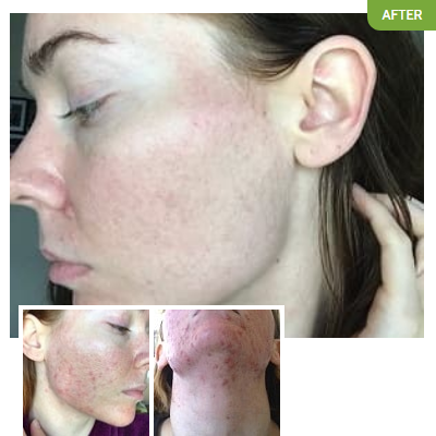 Exposed Skin Care - Rachelle Crouse