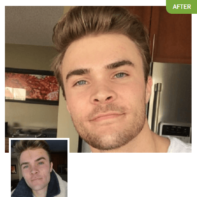 Tyler R. before and after using Exposed Skin Care