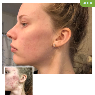 Exposed Skin Care - Victoria M.