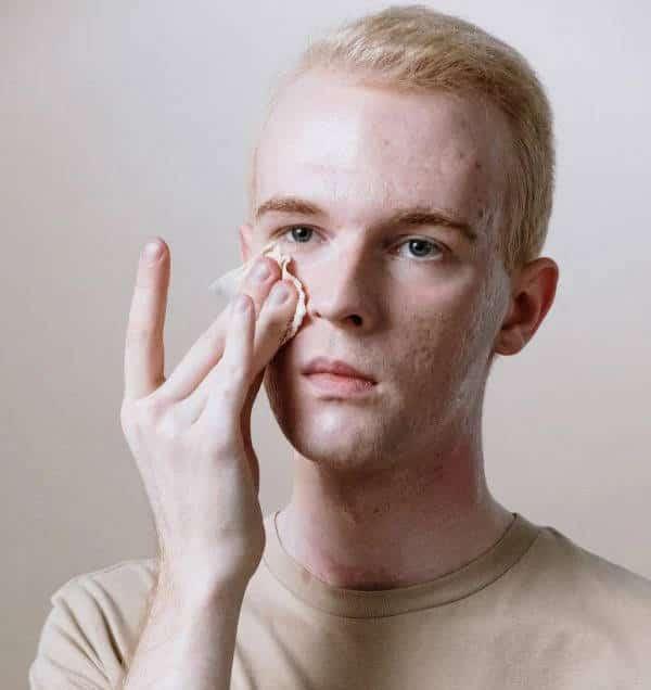 Young man with papule acne cleansing face.