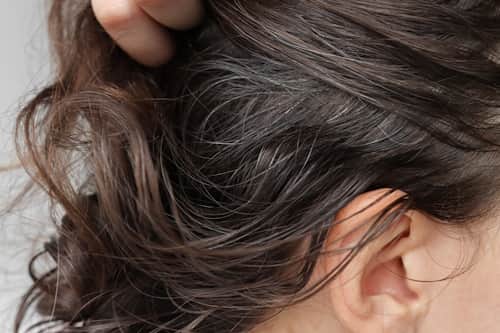 5 Home Remedies for Scalp Acne You Need to Know
