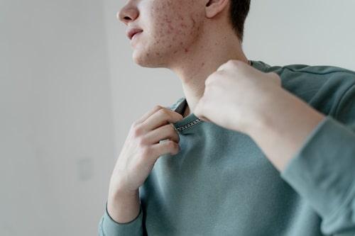 Severe Cystic Acne Treatment (Exposed Works When Others Fail)