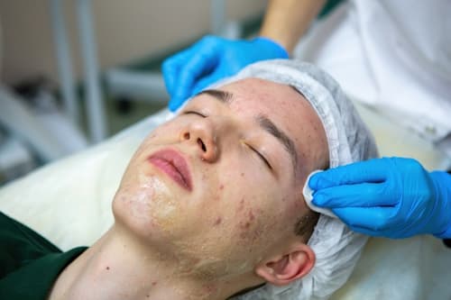 Unveiling the Secret to Clear Skin: A Deep Dive into Facials for Acne