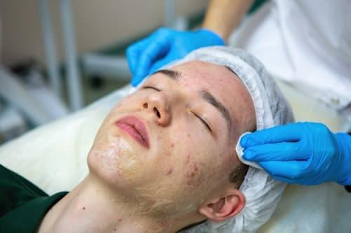 Acne Removal Surgery Options (Or Try Exposed First)