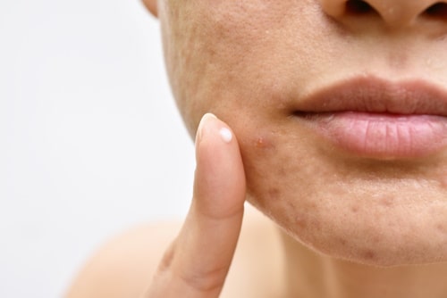 Does Hydrocortisone Help Acne? The Evidence