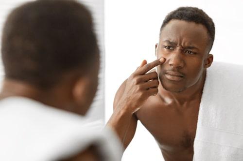 Is Acne Contagious? (Facts You Need to Know)