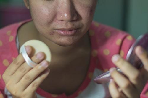 Best Skincare For Dry Acne Prone Skin (The Exposed Routine)