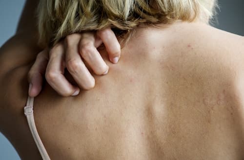 5 Reasons You Should Skip Differin for Back Acne