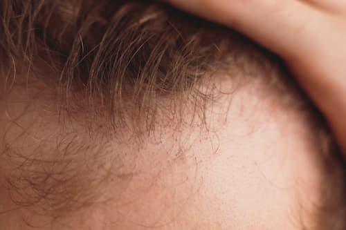Hairline Acne: Causes, Treatments, and Prevention