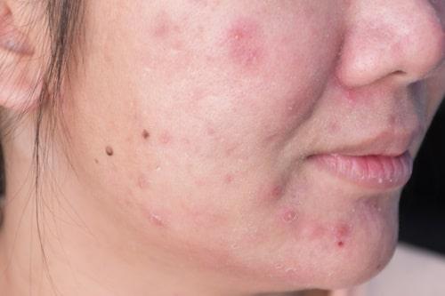 Does Neosporin Help Acne? (This From Exposed Works Better)