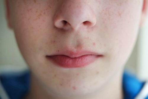 How To Get Rid Of Lip Acne (Without Irritating—Use Exposed)