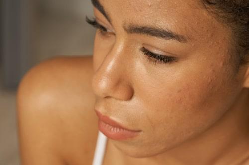How To Get Rid Of Redness From Acne (Exposed Makes It Easy)