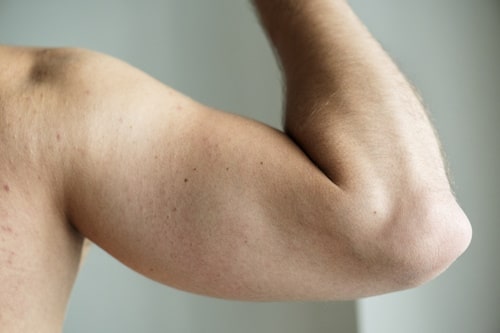 What Is Cystic Acne on Arms? (Causes, Treatments, and More)