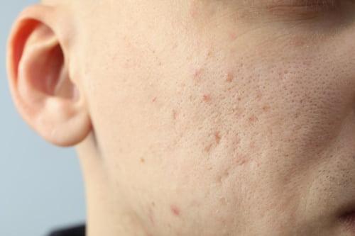 What Is Fungal Acne? (Exposed Clears It With This Routine)