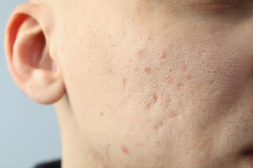 Clogged Pores Acne Fix (Exposed Clears Without Stripping)