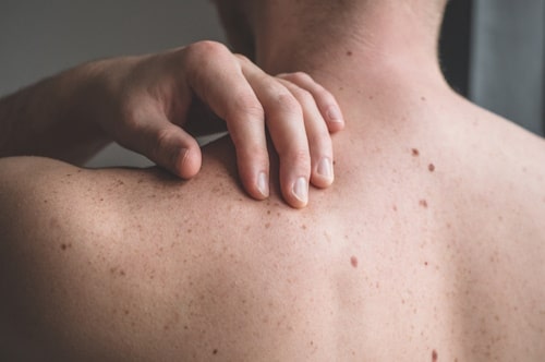 What Causes Back Acne in Males? (What You Need To Know)