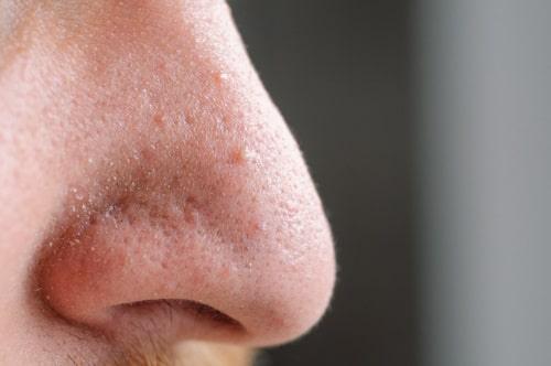 What Is Closed Comedonal Acne? (Causes, Treatments and More)