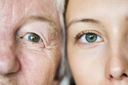 Is Acne Genetic? Understanding the Connection