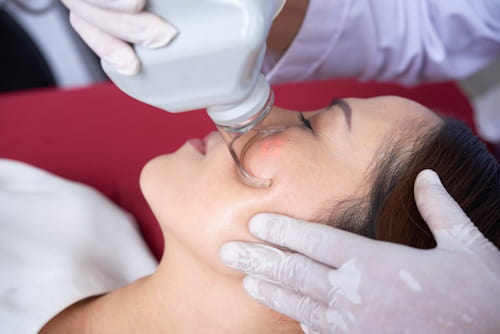 4 Reasons to Avoid Laser Resurfacing Acne Scars