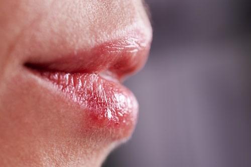 Cystic Acne on Lips (Causes, Treatments and More)