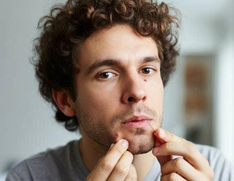 Popping Acne Cyst? (Try This Exposed Fix Instead)