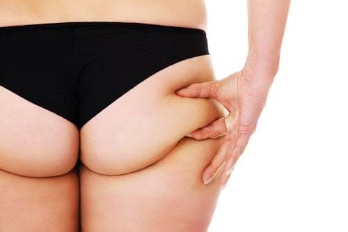 How to Get Rid of Butt Acne: Tips, Treatments, and Prevention