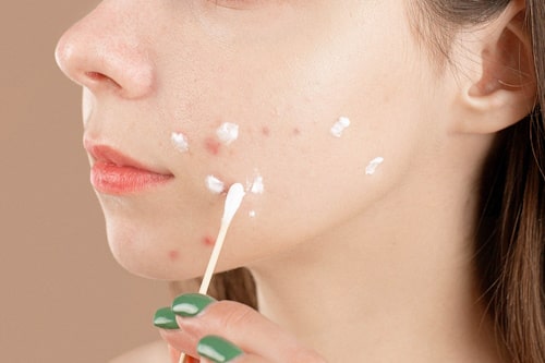 Can Mupirocin Be Used for Acne? (Risks and Alternatives)