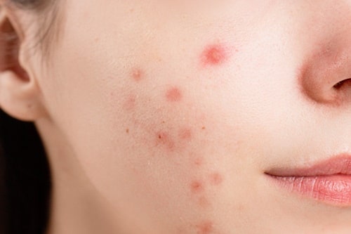 4 Stages of Acne and Targeted Treatments for Each