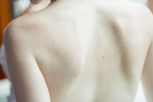 Back Acne Treatment That Works (No Harsh Stuff—Just Exposed)