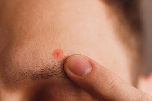 Eyebrow Acne (Your Questions Answered)