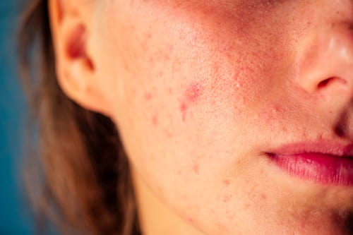 What Are the Causes and Treatments for Red Acne on Face?