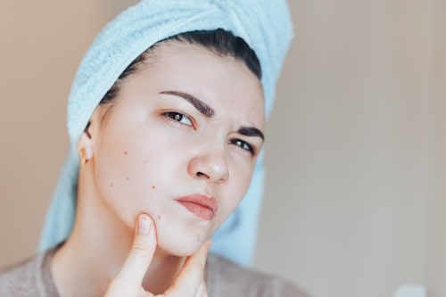 Blemish vs Acne (Everything You Need to Know)