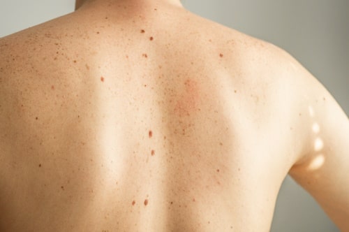 Home Remedies for Back Acne (Everything You Need to Know)